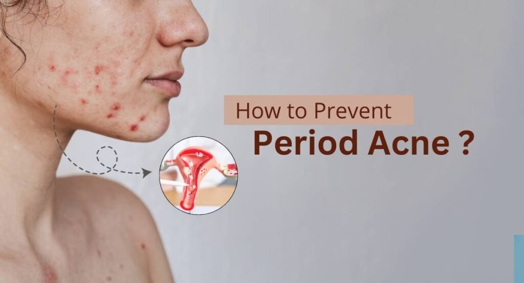 How to Prevent Period Acne